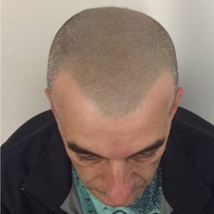 Scalp Micropigmentation Before After