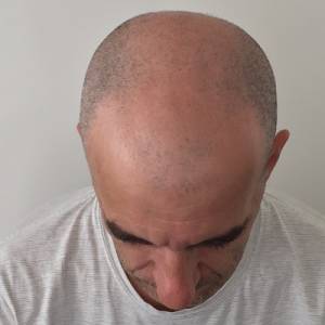 Scalp Micropigmentation Before After