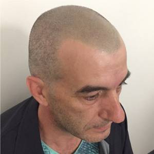 scalp micropigmentation