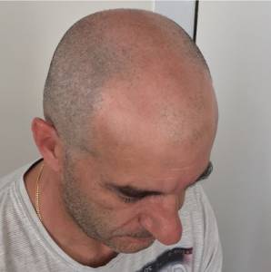 scalp micropigmentation