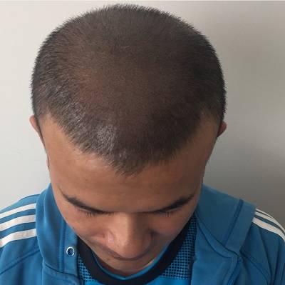 scalp micropigmentation