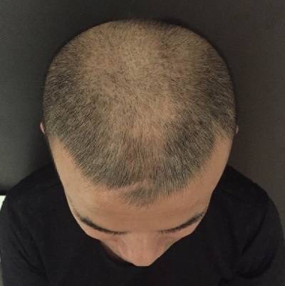 Scalp Micropigmentation
