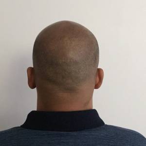 Scalp Micropigmentation