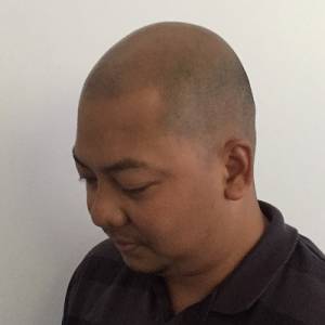 Scalp Micropigmentation