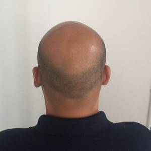 Scalp Micropigmentation