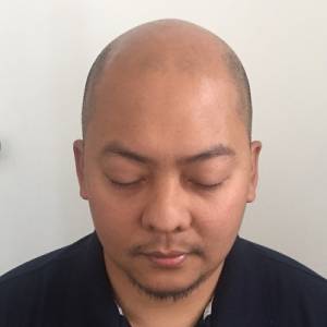 Scalp Micropigmentation