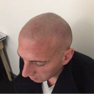 scalp micropigmentation
