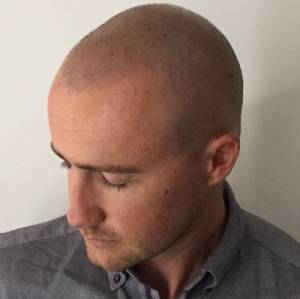 Scalp Micropigmentation