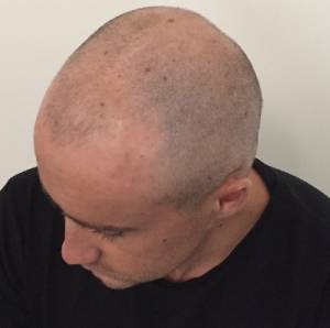 Scalp Micropigmentation