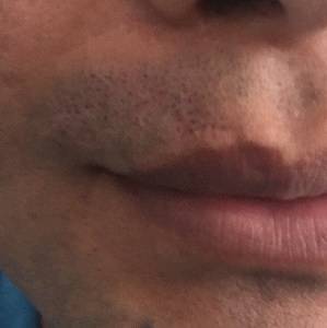 Hair Transplant Scar Tattoo