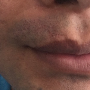 Hair Transplant Scar Tattoo