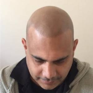 scalp micropigmentation