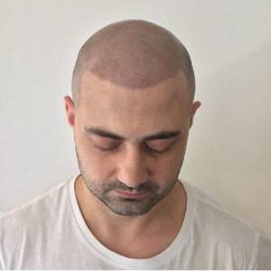 Scalp Micropigmentation Melbourne