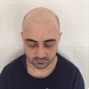 Scalp Micropigmentation Melbourne