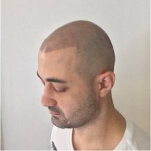 scalp micropigmentation