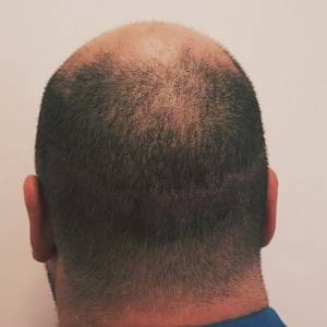 Hair Transplant Scar Tattoo