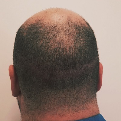 Hair Transplant Scar Tattoo