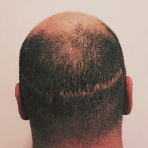 Hair Transplant Scar Tattoo
