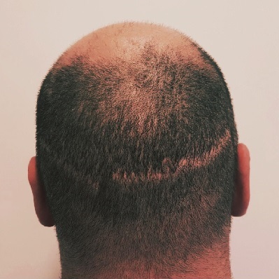 Hair Transplant Scar Tattoo