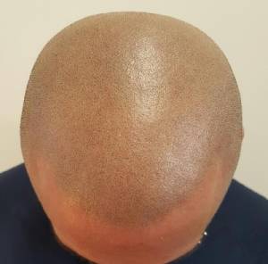 Scalp Micropigmentation