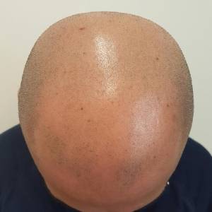 Scalp Micropigmentation