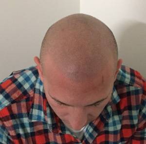 scalp micropigmentation