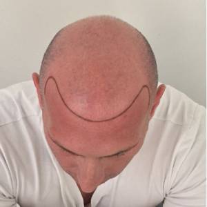 scalp micropigmentation