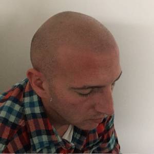 Scalp Micropigmentation Melbourne