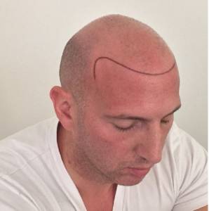 Scalp Micropigmentation Melbourne