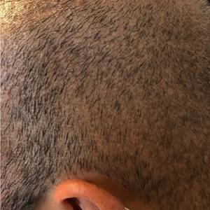 Hair Transplant Scar Tattoo