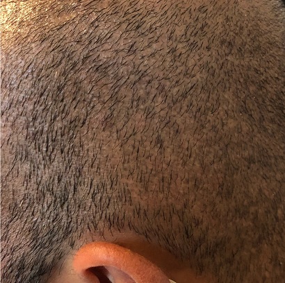 Hair Transplant Scar Tattoo