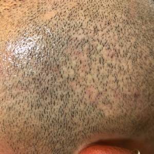 Hair Transplant Scar Tattoo