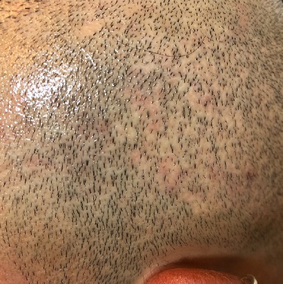 Hair Transplant Scar Tattoo