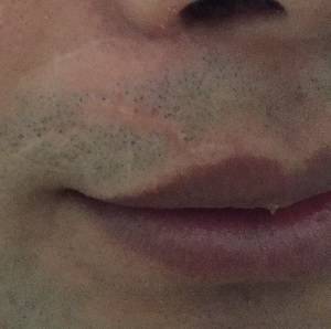 Hair Transplant Scar Tattoo