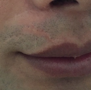 Hair Transplant Scar Tattoo