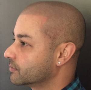 scalp micropigmentation