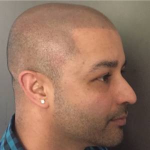 Scalp Micropigmentation Before After