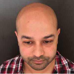 Scalp Micropigmentation Before After