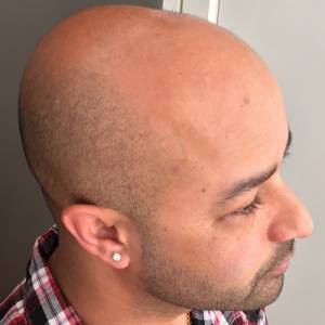 Scalp Micropigmentation Before After