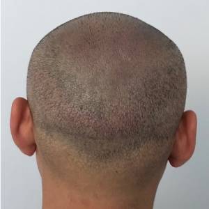 Hair Transplant Scar Tattoo