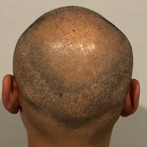 Hair Transplant Scar Tattoo
