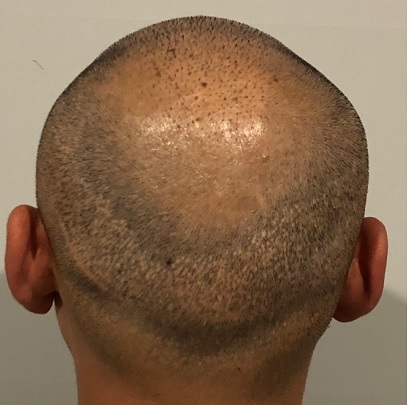 Hair Transplant Scar Tattoo