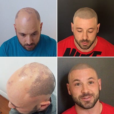scalp micropigmentation alopecia