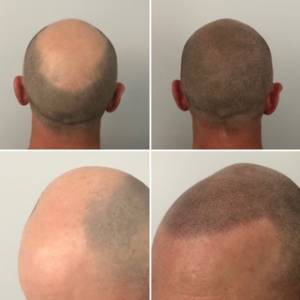 Everything You Need To Know About Scalp Micropigmentation Cost  Scalp  Carolinas  SMP Artist  SMP Classes
