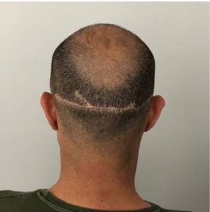 Hair Transplant Scar Tattoo