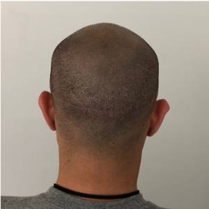 Hair Transplant Scar Tattoo