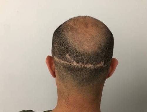 Concealing Hair Transplant Scar