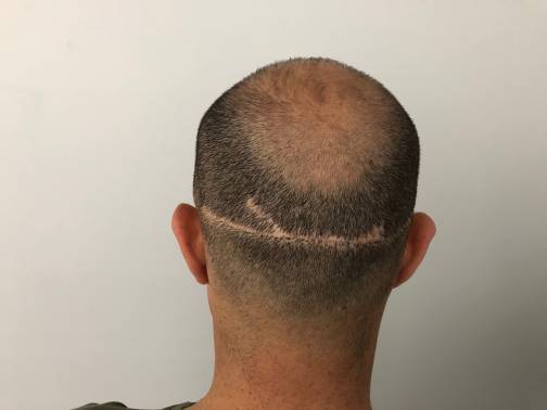 Concealing Hair Transplant Scar