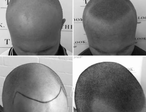 Scalp Micropigmentation Professionals at The Look SMP Clinic