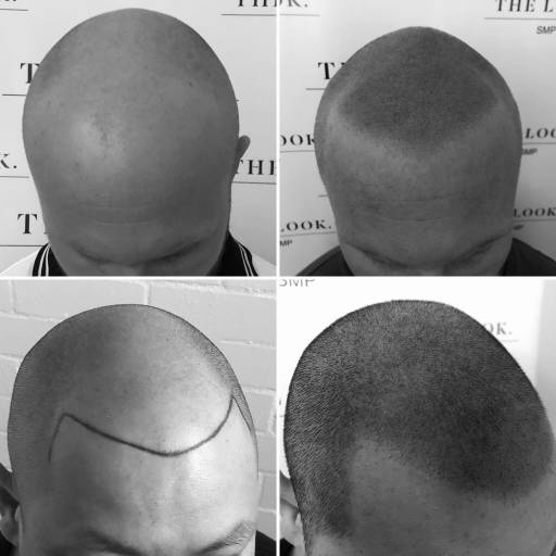 Scalp Micropigmentation Professionals at The Look SMP Clinic